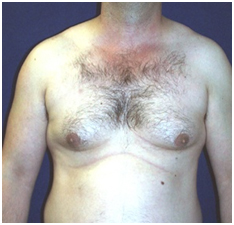 Male Breast Reduction India, Male Breast Reduction Surgery India, Common Disorder Of The Male Breast
