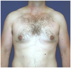 Male Breast Surgery India, Firmer Chests For Men, Bermant, Common Disorder Of The Male Breast