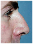 Rhinoplasty, Nose Surgery, Face, Rhinoplasty Nose Surgery, India Hospital Tour