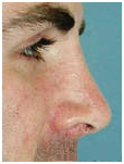 Rhinoplasty, Nose Surgery, Rhinoplasty India, Face,India Hospital Tour