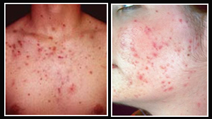 Laser Scar Removal, Scar Removal Creams, Scar, Scar Improvement, Effective Scar Removal