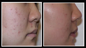 scar removal surgery cost in delhi