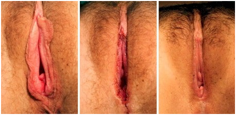 Vaginoplasty, Vaginal Rejuvenation, Vaginoplasty Surgery India