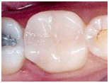 Cost Ceramic Dental Inlay, Dental Inlay, Dental Gold Inlay, Dental Inlay On Lay