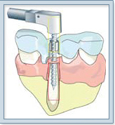Dental Implant India, Affordable Dental Implants Dentist India
