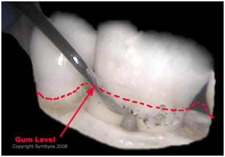 Dental Teeth Scaling India, Cost Dental Scaling Hospital India, Dental Scaling India, Dental Caps