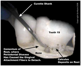 Cost Dental Scaling Hospital India, Dental Ultrasonic Scaling, , Dental Bonding, Dental Caps, Dental Fillings