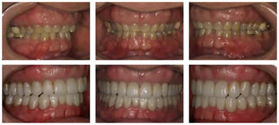 Dental Implants India, Full Mouth Dental, Dental Implants India, Full Mouth Restoration Delhi  India