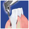 Dental Laser Treatment, Laser Dental Clinic In India