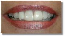 Laser Dentistry, Dental Laser Treatment, Laser Dental Clinic In India, Laser Root Canal Treatment