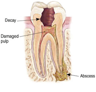Root Canal Treatment India, Root Canal Treatment Delhi India, Root Canal Treatment India
