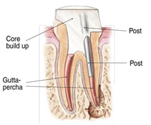 Root Canal Treatment India, Root Canal Specialist