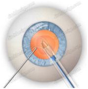 Intraocular Lens Implant, IOL,  Intraocular Lens, India Hospital Tour