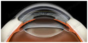 India Intraocular Lenses, Intraocular Lenses, IOL, Intraocular Lens Implantation