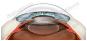 Intraocular Lenses, IOL, Intraocular Lens Implantation