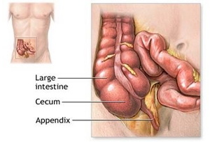 Appendectomy offers info on Appendectomy Appendix Surgery India, Appendix Removal India,Laparoscopic Appendectomy India, Appendectomy Appendix Surgery   India, Open Appendectomy India