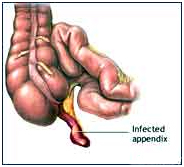 Appendix Removal India, Laparoscopic Appendectomy India, Appendectomy Appendix Surgery India, Open Appendectomy India