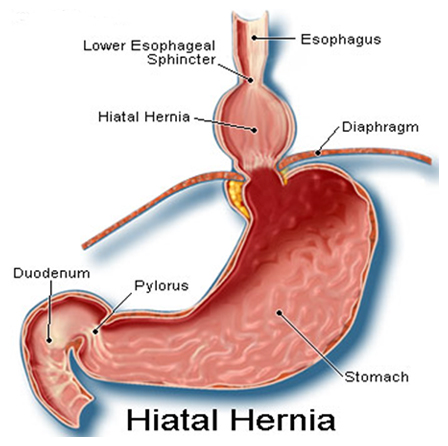 Hiatus Hernia India, Hiatal Hernia India, Hernias India, Gastric Hiatus Hernia Surgery India