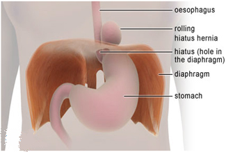 Gastric Hiatus Hernia Surgery offers info on Gastric India, Paraesophageal Hernias India, Gastric Hiatus Hernia Surgery India