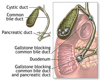 Stone Diseases offers info on Stone Diseases Treatment India, Urinary Stone Disease India, Stone Disease Treatment   India