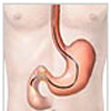 Cost Gastric- Duodenal Ulcer Treatment Hospital India, Gastric Ulcers Treatment  India