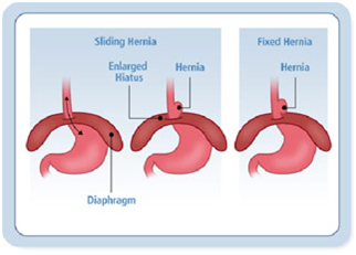Hiatus Hernia offers info on Hiatus Hernia Surgery India, Hiatus Hernia India, Hiatal Hernia India, Stomach India
