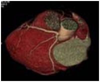 CardiacCT Angiography offers info on 64 Slice CT  India, 64slice CT Angiography  India