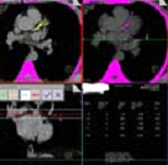 64slice CT Angiography  India, 64 Slice CT Scan  India, Light Speed VCT  India, Angiography  India