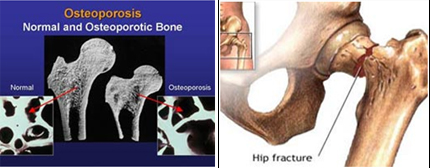 DEXA Scan offers info on Bone Densitometry Osteoporosis Scan  India, Bone  India