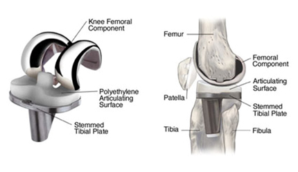 High Flex Knee Replacement, High Flex Knee Replacement Procedure, High Flexion