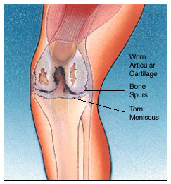 TKR, Surgery Activities, Knee Replacement Surgeon, Total Knee Replacement Surgery Risks