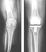 Knee Replacement Surgery India Knee Replacement Surgery, Knee Replacement, Knee