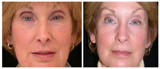 Laser Facial Wrinkle Removal Surgery India offers info on Face Tightening Uplift India, White Patch Removal Surgery India