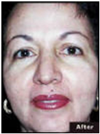 Brown & Age Spot Removal Treatment India, Cost Brown & Age Spot Removal Treatment India