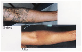 Tattoo Removal Laser Surgery India,India Tattoo Removal Surgeons India