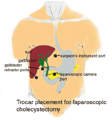 Cholecystectomy Surgery offers info on Cholecystectomy India, Laparoscopic Cholecystectomy India
