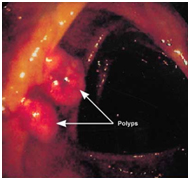 Colon Polyp Removal Surgery  India, Cost Colon Polyp Removal Surgery India