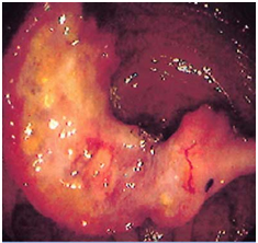 Colon Polyp Removal Surgery India offers info on Cost Colon Polyp Removal Hospital India, Colon Polyp Removal Surgery  India, Colon Polyp Removal Surgery India