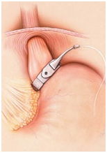 Gastric Banding Surgery offers info on Adjustable Gastric Banding India, Gastric Banding India, Advanced Adjustable Gastric Band India