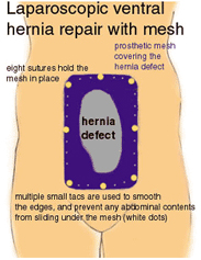 Hernia Repair Surgery India, Open Hernia Repair India