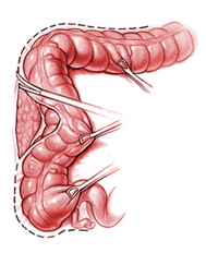 Laparoscopic Colectomy Surgery India offers info on Cost Colectomy Surgery Hospital India, Colon Cancer India