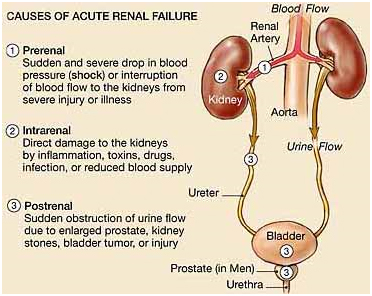 Prevalence Of Chronic Renal Failure In Adults In India, Renal Failure Surgery India