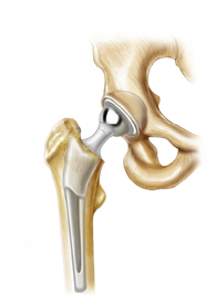 Joint Replacement Surgery India, Joint Replacement India, Damaged Joint