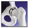 Joint Replacement Surgery India, Joint Replacement India
