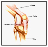 Damaged Joint, Removing Damaged Joint, Joint Replacement Surgery India