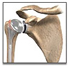 Joint Replacement India, Removing Damaged Joint, Joint Replacement Surgery India, Joint Replacement In India