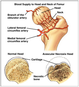 Avascular Necrosis Treatment India offers info on Avascular Necrosis Hospital India, Stem Cell Therapy Avascular Necrosis India