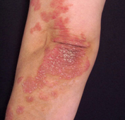 Stem Cell Therapy Psoriasis India, Stem Cell Therapy Psoriasis India, Stem Cell Therapy Guttate Psoriasis India
