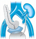 Pancreatic Transplant Surgery India offers info on Pancreas Transplant Surgery India, Organ Transplant  India