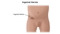 Inguinal Hernia India, Inguinal Hernia Cause India, Inguinal Hernia Symptom India, Inguinal Hernia Diagnosis India